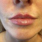 An After Photo of Restylane Kysse Lip Filler In Seattle and Tacoma