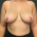 An After Photo of a Breast Lift With Auto Augmentation by Dr. Craig Jonov in Seattle and Tacoma