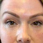 An After Photo of Under Eye Fillers In Seattle and Tacoma