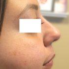 An After Photo of a Non-Surgical Rhinoplasty in Seattle and Tacoma