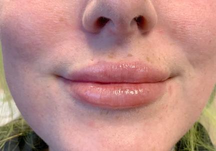 An After Photo of Restylane Kysse Lip Filler In Seattle and Tacoma
