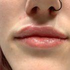 An After Photo of Restylane Refyne Lip Filler In Seattle and Tacoma