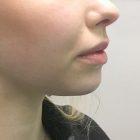 An After Photo of Chin Filler In Seattle and Tacoma