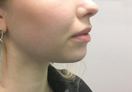 An After Photo of Chin Filler In Seattle and Tacoma