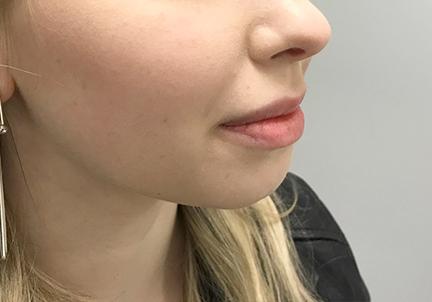 A Before Photo of Chin Filler In Seattle and Tacoma
