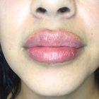 An After Photo of Restylane Kysse Lip Filler In Seattle and Tacoma