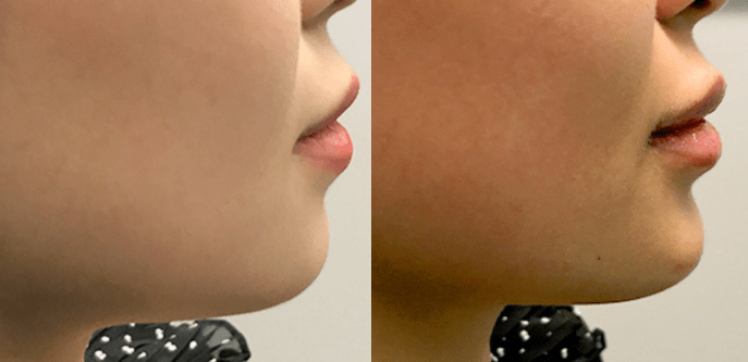A Before & After Photo of Chin Filler In Seattle & Tacoma
