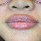 An After Photo of Restylane Kysse Lip Filler In Seattle and Tacoma