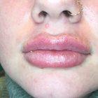 An After Photo of Restylane Kysse Lip Filler in Seattle and Tacoma