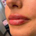 An After Photo of Restylane Kysse Lip Filler In Seattle and Tacoma