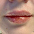 An After Photo of Restylane Defyne Lip Filler In Seattle and Tacoma