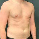 An After Photo of Gynecomastia Plastic Surgery by Dr. Craig Jonov in Seattle and Tacoma