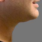 An After Photo of Kybella Injections In Seattle and Tacoma