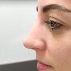 An After Photo of a Non-Surgical Rhinoplasty In Seattle and Tacoma