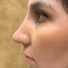 An After Photo of a Non-Surgical Rhinoplasty In Seattle and Tacoma