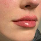 An After Photo of Juvederm Ultra Lip Filler In Seattle and Tacoma