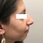 A Before Photo Of A Rhinoplasty Plastic Surgery by Dr. David Santos in Seattle and Tacoma
