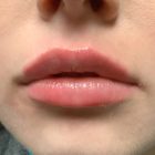 An After Photo of Lip Filler In Seattle and Tacoma
