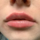 An After Photo of Lip Filler In Seattle and Tacoma