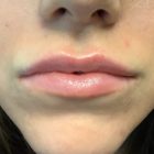 An After Photo of Juvederm Ultra Plus Lip Filler In Seattle and Tacoma