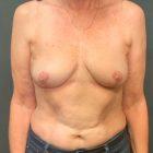 An After Photo of A Breast Lift With Explant Plastic Surgery by Dr. Craig Jonov in Seattle and Tacoma