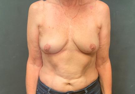An After Photo of A Breast Lift With Explant Plastic Surgery by Dr. Craig Jonov in Seattle and Tacoma