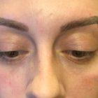An After Photo of Under Eye Filler In Seattle and Tacoma