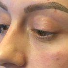 An After Photo of Under Eye Filler In Seattle and Tacoma