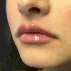 An After Photo of Lip Filler in Seattle and Tacoma