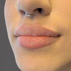 An After Photo of Restylane Kysse Lip Filler In Seattle and Tacoma