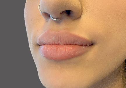 An After Photo of Restylane Kysse Lip Filler In Seattle and Tacoma