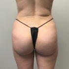 An After Photo of a Brazilian Butt Lift Plastic Surgery In Seattle and Tacoma