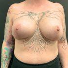An After Photo of Breast Augmentation With Lift Plastic Surgery In Seattle and Tacoma
