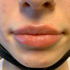 An After Photo of a Restylane Kysse Lip Filler in Seattle and Tacoma