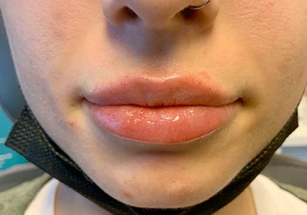 An After Photo of a Restylane Kysse Lip Filler in Seattle and Tacoma