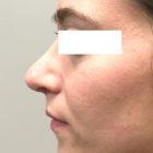 An After Photo of a Rhinoplasty Plastic Surgery by Dr. David Santos In Seattle and Tacoma