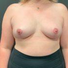 An After Photo of a Breast Lift With Auto Augmentation Plastic Surgery by Dr. Craig Jonov in Seattle and Tacoma