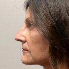 An After Photo of a Rhinoplasty Plastic Surgery by Dr. David Santos in Seattle and Tacoma