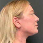 An After Photo of a Facelift Plastic Surgery by Dr. Craig Jonov in Seattle and Tacoma