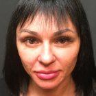 An After Photo of Sculptra Injections In Seattle and Tacoma