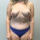 An After Photo of a Mommy Makeover Plastic Surgery by Dr. Craig Jonov in Seattle and Tacoma