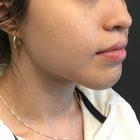 An After Photo of a Chin Augmentation Plastic Surgery by Dr. Craig Jonov in Seattle and Tacoma