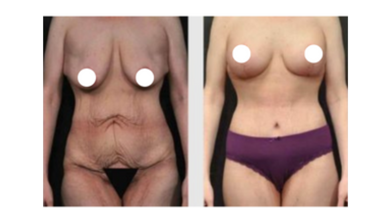 A Before & After Photo of a Tummy Tuck with Thigh Lift Plastic Surgery by Dr. Craig Jonov