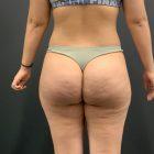An After Photo of Brazilian Butt Lift Plastic Surgery by Dr. Craig Jonov in Seattle and Tacoma