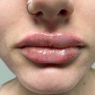 An After Photo of Restylane Kysse Lip Filler in Seattle and Tacoma