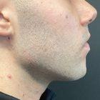 An After Photo of Jaw Filler in Seattle and Tacoma
