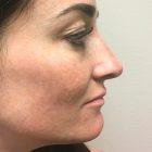An After Photo of a Non-Surgical Rhinoplasty In Seattle and Tacoma