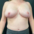 An After Photo of an Auto Breast Augmentation With Lift Plastic Surgery by Dr. Craig Jonov in Seattle and Tacoma
