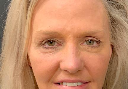 An After Photo of Upper and Lower Blepharoplasty by Dr. Craig Jonov in Seattle and Tacoma