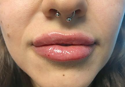 An After Photo of Restylane Kysse Lip Filler in Seattle and Tacoma